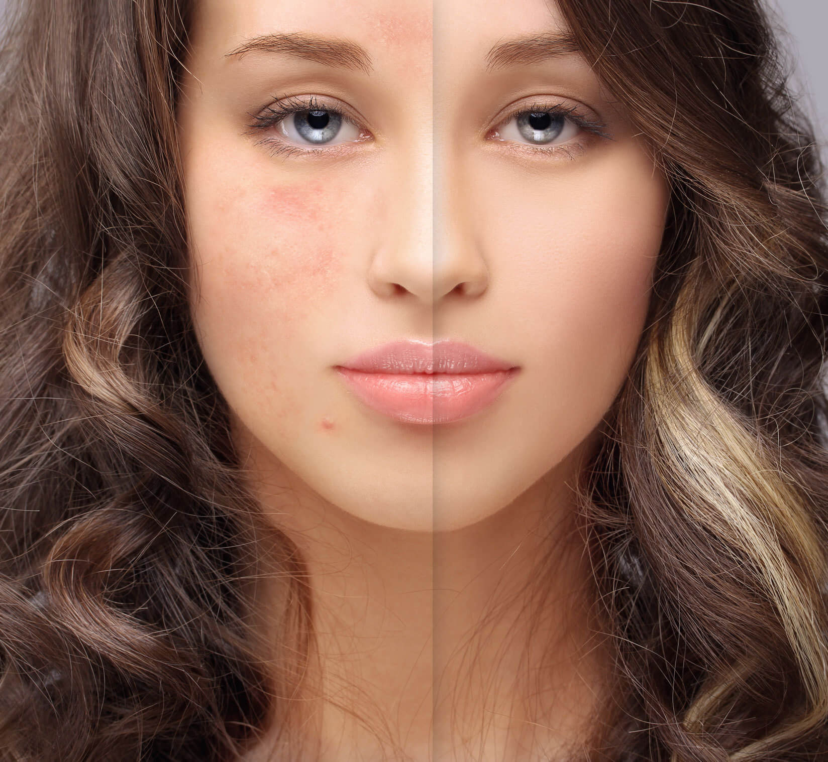 Pure Skin Professional - unreine Haut behandlung in Berlin