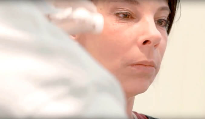 Video Thumb - Fadenlift Augen