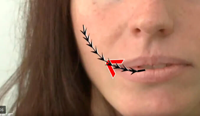 Video Thumb - Mundwinkel Lifting